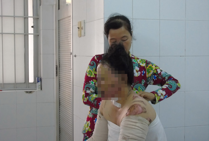 Bà Vình bị bỏng 32%.