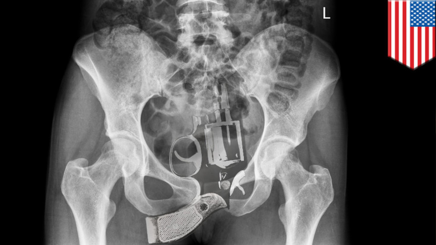 Cô gái bị phát hiện giấu súng vào... vùng kín 