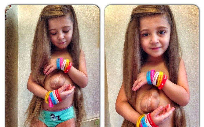 Kỳ lạ bé gái có quả tim 'đặt nhầm chỗ'