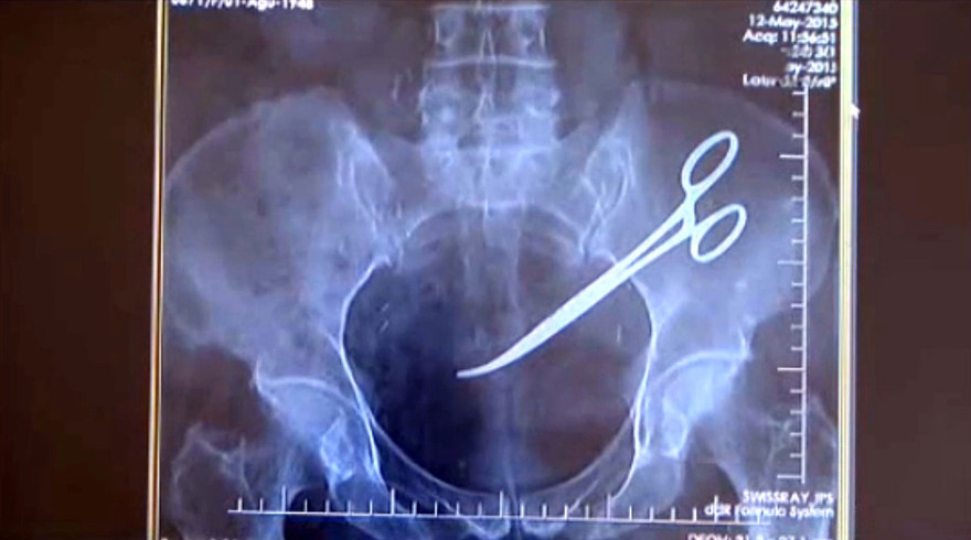 Bác sĩ để quên kéo trong ổ bụng bệnh nhân suốt 5 năm 