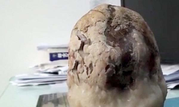 Cận cảnh viên sỏi mật với kích thước "khủng"