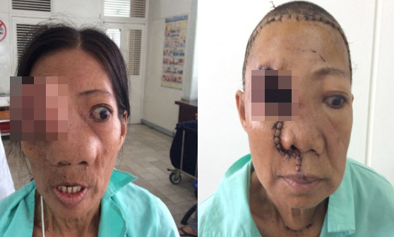 Bà Đ. trước và sau khi được phẫu thuật. Ảnh do bệnh viện cung cấp.