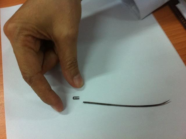 Chiếc kim đã đâm vào mắt bé P. và phần đuôi bị gãy “di chuyển” trong hốc mắt bệnh nhi. Ảnh: Quốc Ngọc 