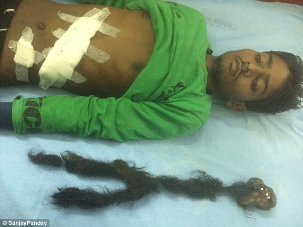 Nam thanh niên và 'thai nhi' sau khi trải qua ca phẫu thuật.