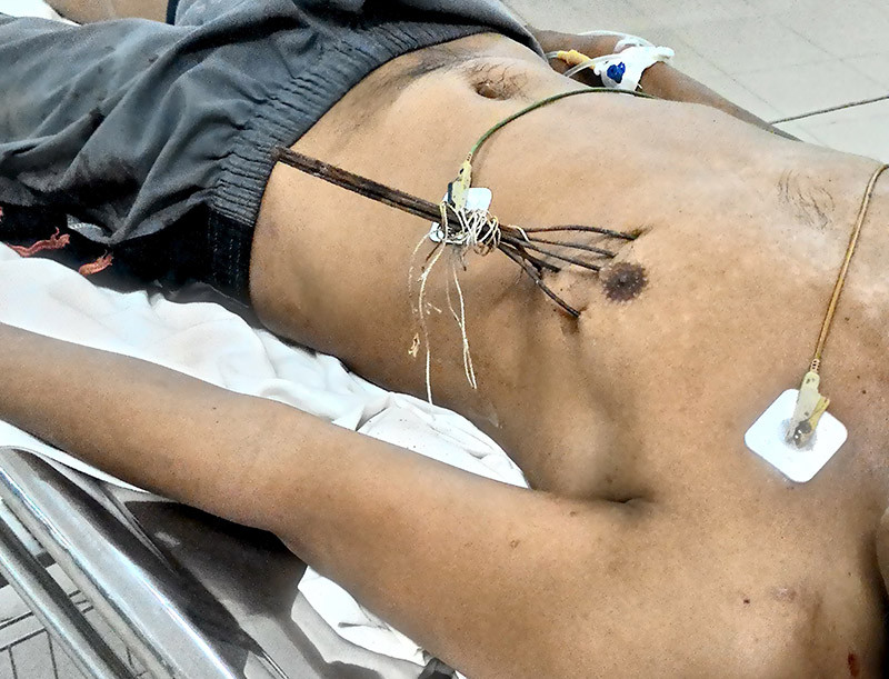 Bệnh nhân Nguyễn Phúc Duy lúc mới nhập viện.