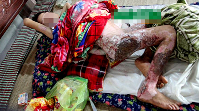 Cậu bé T. bị bỏng nặng sau khi bị mẹ đẩy vào đống lửa