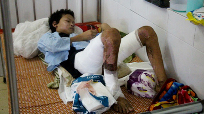 Cháu T. bị bỏng trên 40% và hiện không có phần da nào để tiến hành cấy ghép