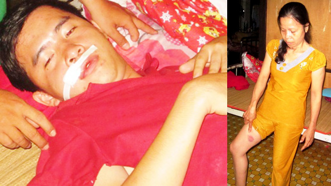 Anh Giang bị trọng thương ở mặt đang điều trị ở bệnh viện và vết thương ở đùi của bà Thuỷ sau khi bị Phó trưởng công an xã bắn