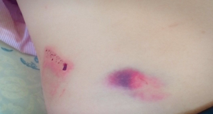 Thương tích trên người ông Th. Ảnh B.N