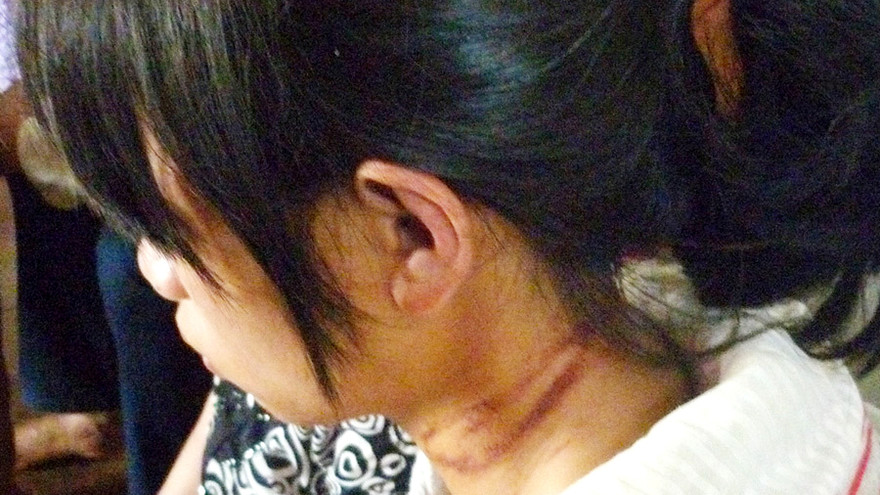 Vết thương trên cổ cháu Linh. Ảnh: Phan Thương