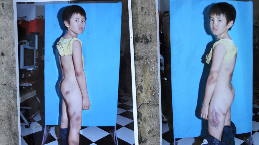 Những vết thương trên cở thể cháu Anh sau khi bị đánh được người dân căm phẫn chụp lại dán khắp nơi