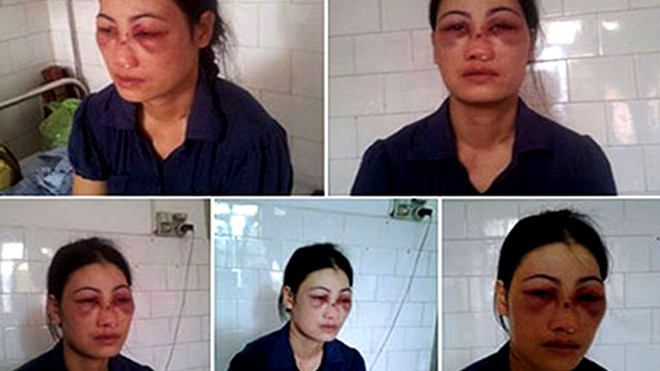 Chị Hoa với đầy thương tích trên khắp cơ thể sau khi bị chồng bạo hành