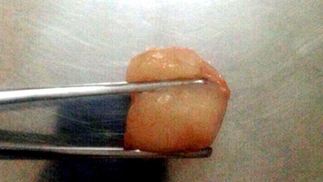 Quả vải gây ra cái chết thương tâm cho bé trai 6 tuổi