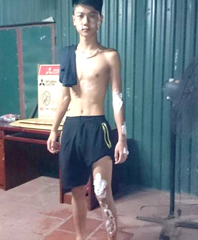 Một người đi đường bị bỏng do a xít trong xe tải bắn ra ngoài