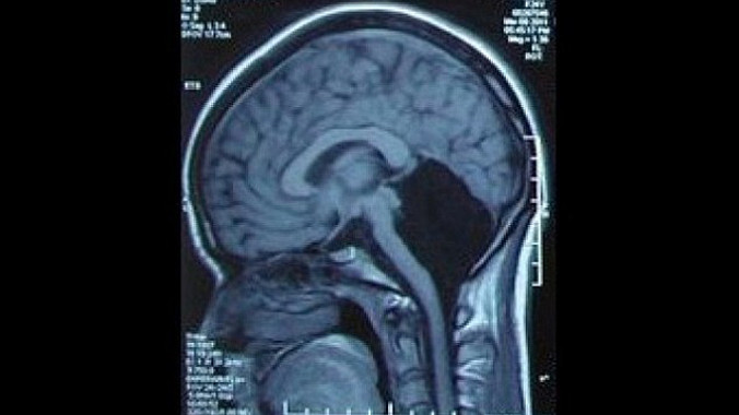 Mất nửa não bộ, vẫn sống bình thường