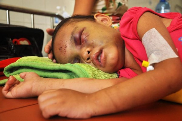 Khuôn mặt cháu bé 4 tuổi bầm dập vì bố mẹ 'dạy dỗ'