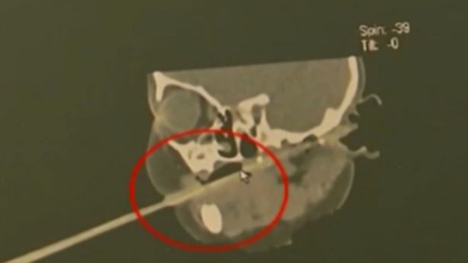 Phim chụp hình ảnh đũa kẹt trong họng bé 1 tuổi.