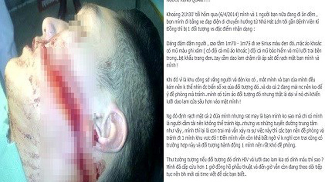 Hình ảnh nam sinh bị rạch mặt đưa chia sẻ trên Facebook cá nhân