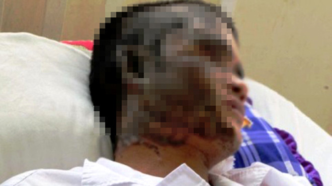 Anh C với khuôn mặt bị biến dạng bởi a xít