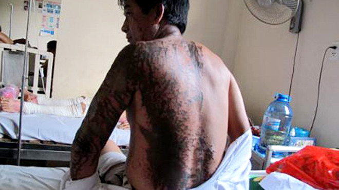 Ông Hà hứng trọn ca axit của hai kẻ lạ mặt