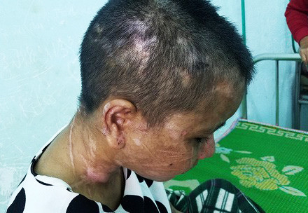 Hàng trăm vết thương từ đầu xuống chân Y Nhiêu