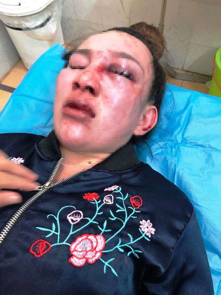 Chị V đang điều trị tại bệnh viện