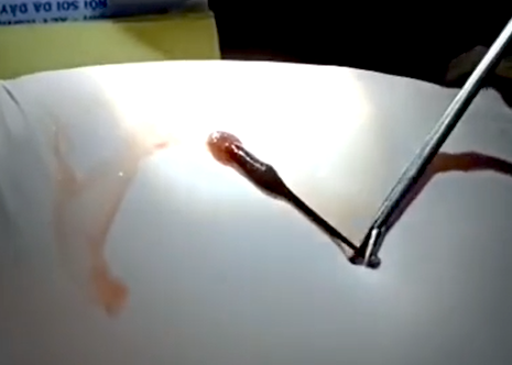 Con đỉa đã được gắp ra khỏi mũi nạn nhân