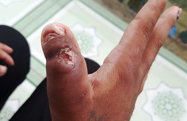 Vết thương tàn ác mà bà Hà gây ra cho chị Y Nhiêu