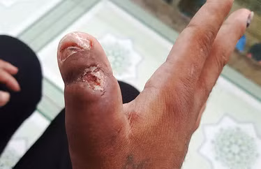 Vết thương tàn ác mà bà Hà gây ra cho chị Y Nhiêu