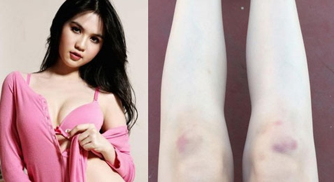 Hoa vương Châu Á gặp nạn; Ngọc Trinh khoe đôi chân bầm tím