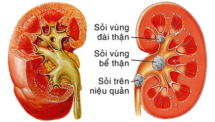 Sỏi thận - Ngăn ngừa tái phát trong điều trị