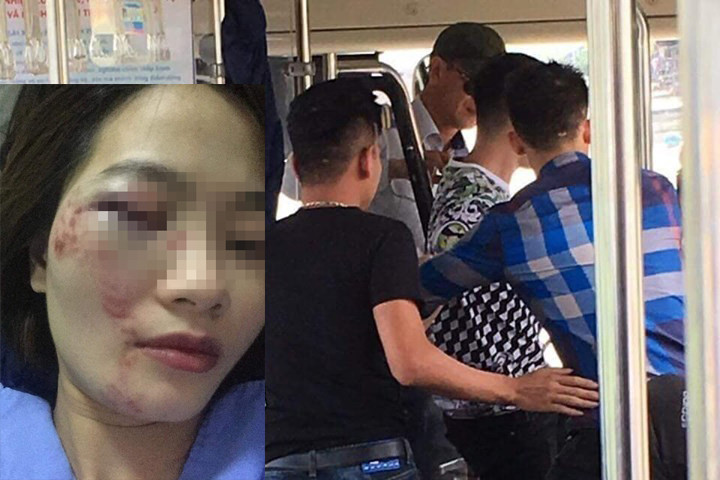 Chị H. bị nhóm thanh niên đánh thâm tím mặt.