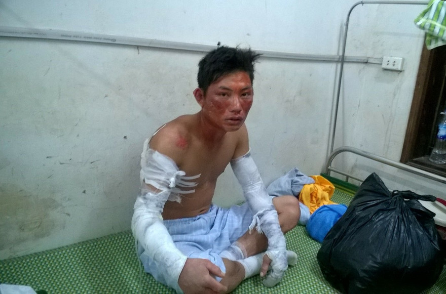 Nạn nhân Hà Văn Hiếu vẫn chưa hết bàng hoàng sau vụ nổ.