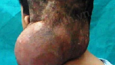 Khối u "khủng" trên đầu bệnh nhân C. Ảnh: BS cung cấp.