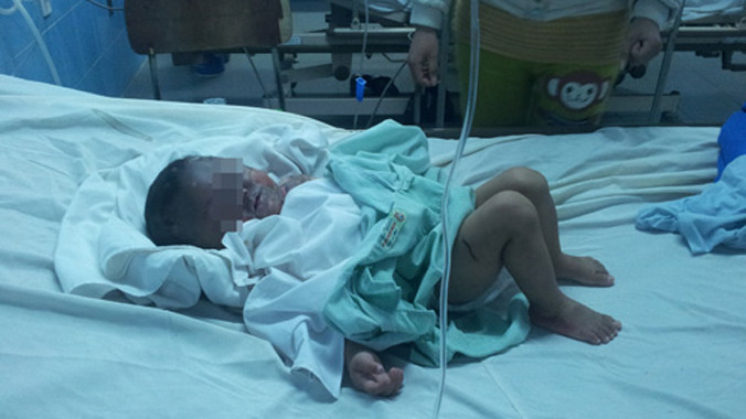 Cháu bé bị bỏng đang điều trị tại bệnh viện.