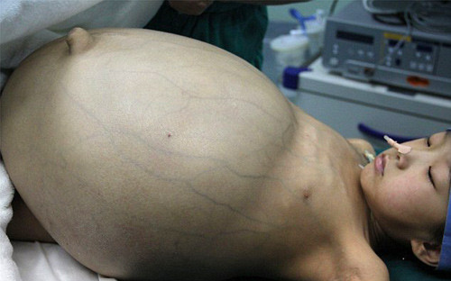 Khối u có kích thước lớn hơn hai quả bóng đá và nặng gần 15 kg. Ảnh: Getty Images.