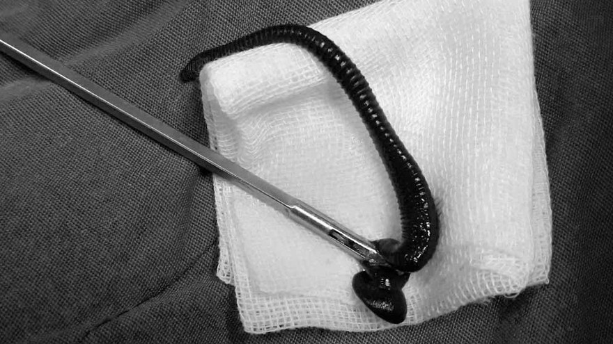 Con vắt nằm trong khí quản ông A Bói được bác sĩ gắp ra