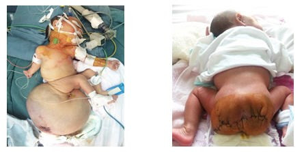 Bệnh nhi trước và sau khi được phẫu thuật. Ảnh: Kiến Thức