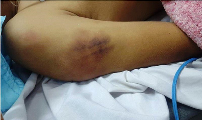 Người nhà anh Tuấn cung cấp hình ảnh trên bắp tay phải của anh có vết bầm