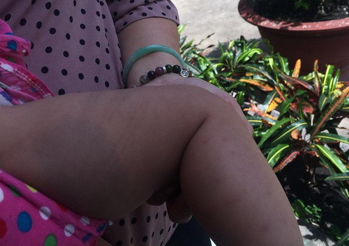 Vết bầm ở chân cháu bé nghi bị bà Loan đánh.