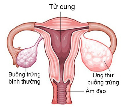 Bạn biết gì về ung thư buồng trứng?