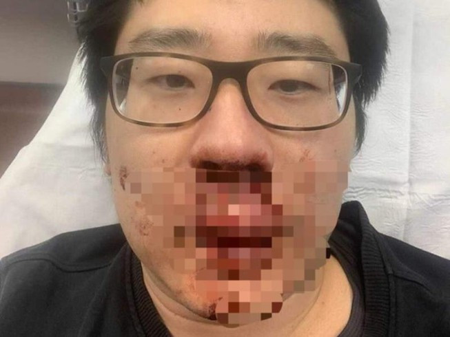 Ông Peng Wang sau khi bị tấn công. (Ảnh: FB)