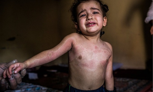 Shahad, con gái của Abu Anas, phải chịu nhiều vết bỏng trên cơ thể do ảnh hưởng từ chất độc hóa học chứa trong những quả đạn pháo mà IS dội xuống nhà em. Ảnh: New York Times.