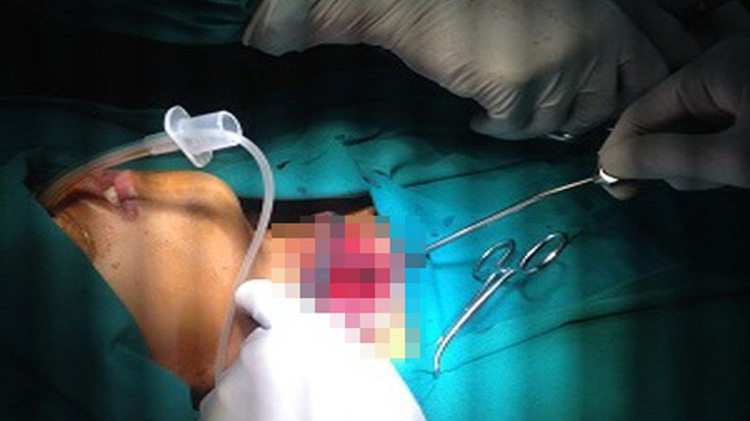 Các bác sĩ thực hiện ca ghép nối khí quản cho bệnh nhi Đức. Ảnh: Bệnh viện cung cấp.