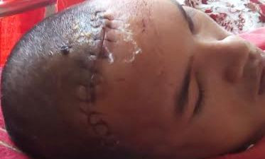 Anh Nhân bị chấn thương sọ não 