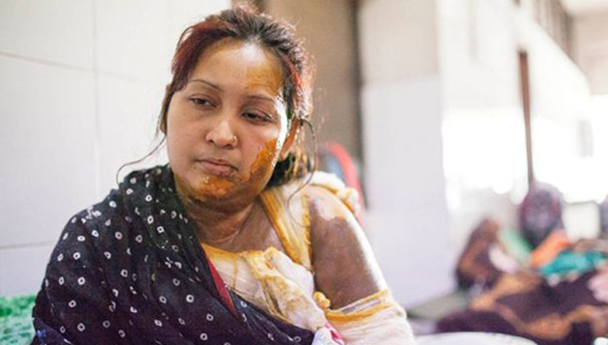 Tania bỏng hết phần mặt và tay bên trái. Ảnh: Barcorft Media.