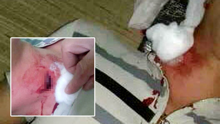 Vết thương trên cổ nạn nhân