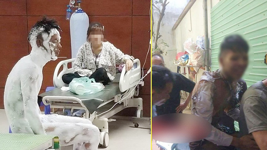 Nam thanh niên tự thiêu được xác định bỏng độ 3. (Ảnh: Beat.vn)