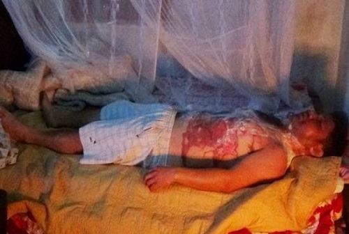 Anh Nam bị bỏng nặng sau khi bị vợ dội ấm nước sôi lên người