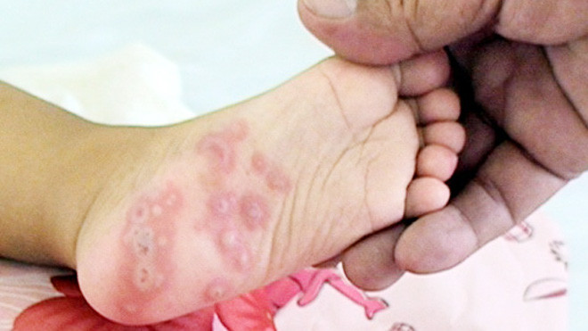 Biểu hiện nốt phỏng ở lòng bàn chân trong bệnh tay chân miệng 